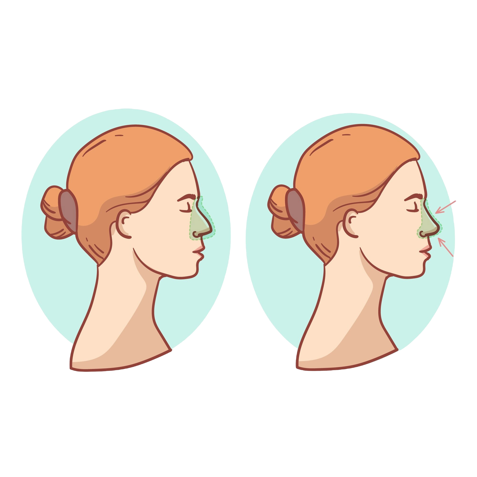 hand-drawn-rhinoplasty-illustration